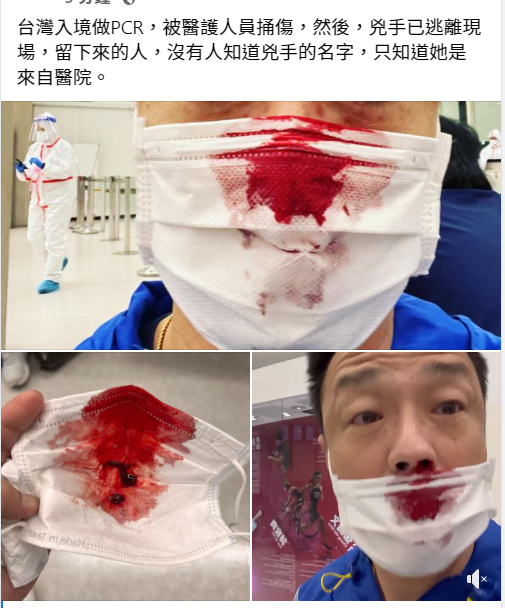 王喜在社交平台展示傷勢。